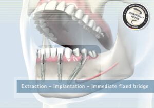 Implanturi dentare Fast and Fixed
